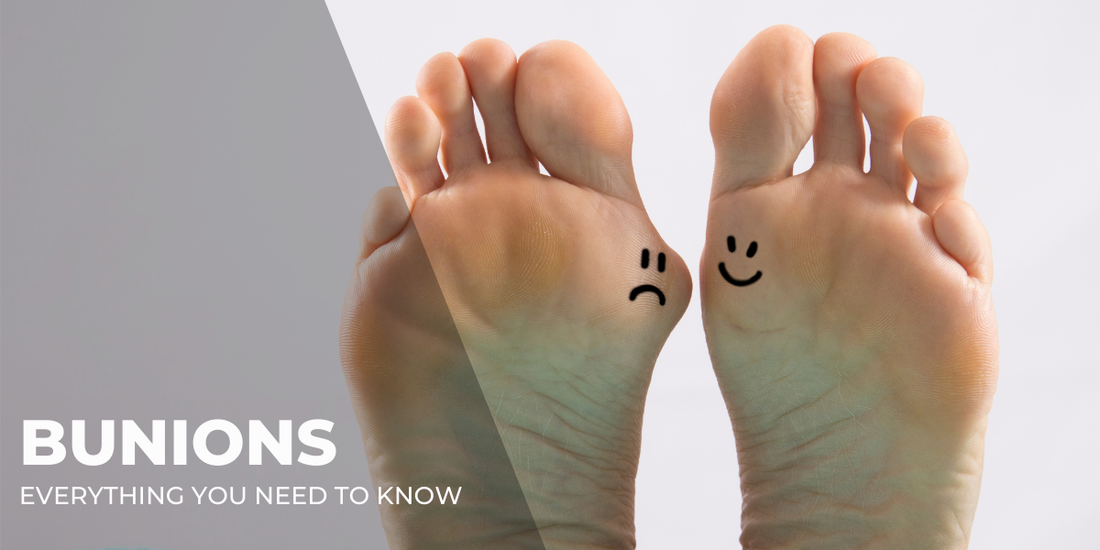 Everything You Need to Know About Bunions (and What You Probably Didn’t Know)